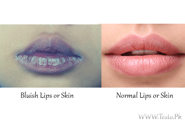 Bluish Lips or Skin